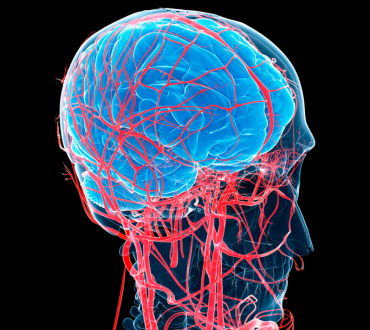 tętniaki tętnic mózgowych